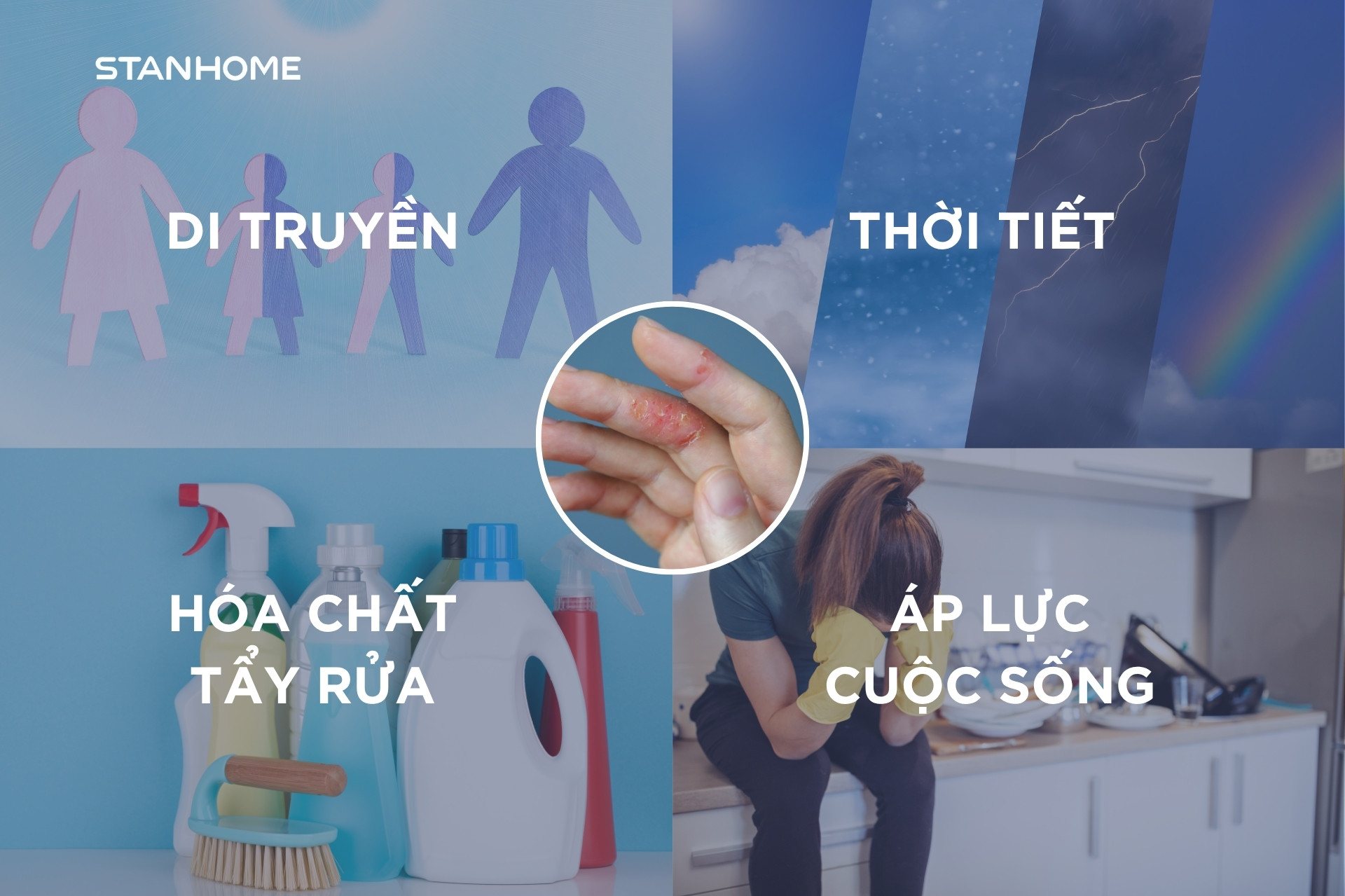Viêm da cơ địa ở tay có thể xuất phát từ nhiều nguyên nhân khác nhau như di truyền, thay đổi thời tiết, tiếp xúc thường xuyên với chất tẩy rửa hay áp lực tinh thần dẫn đến stress