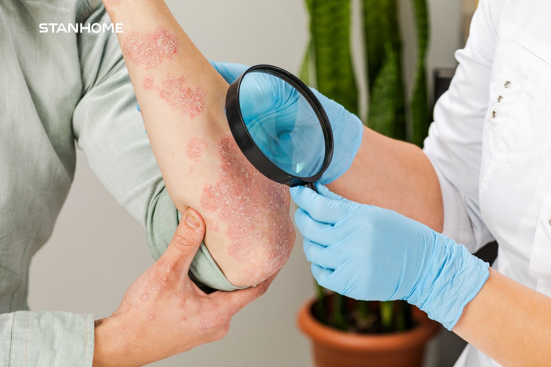 Phương pháp điều trị vảy nến