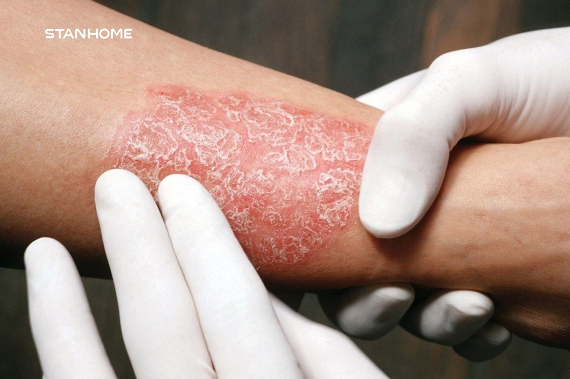 Tổng quan về bệnh vảy nến