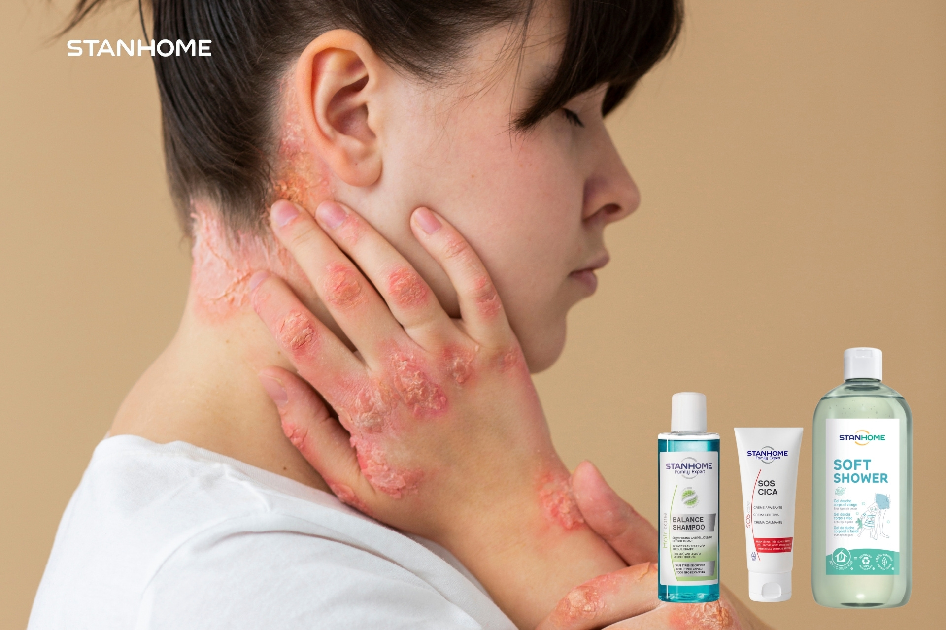 Cách chăm sóc vảy nến tại nhà và lối sống hỗ trợ điều trị