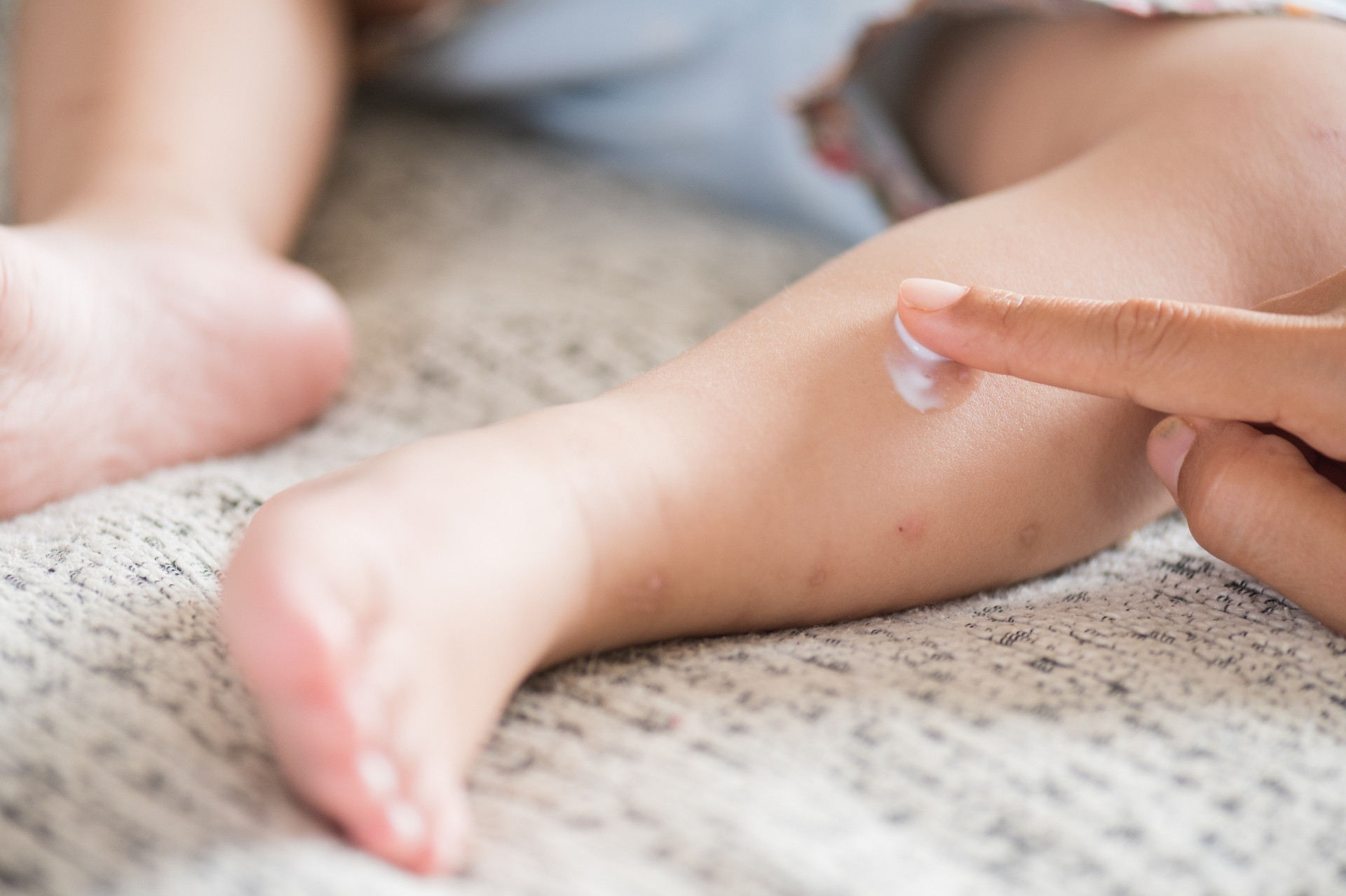 Da gặp các vấn đề về da liễu khi vi hệ microbiota mất cân bằng