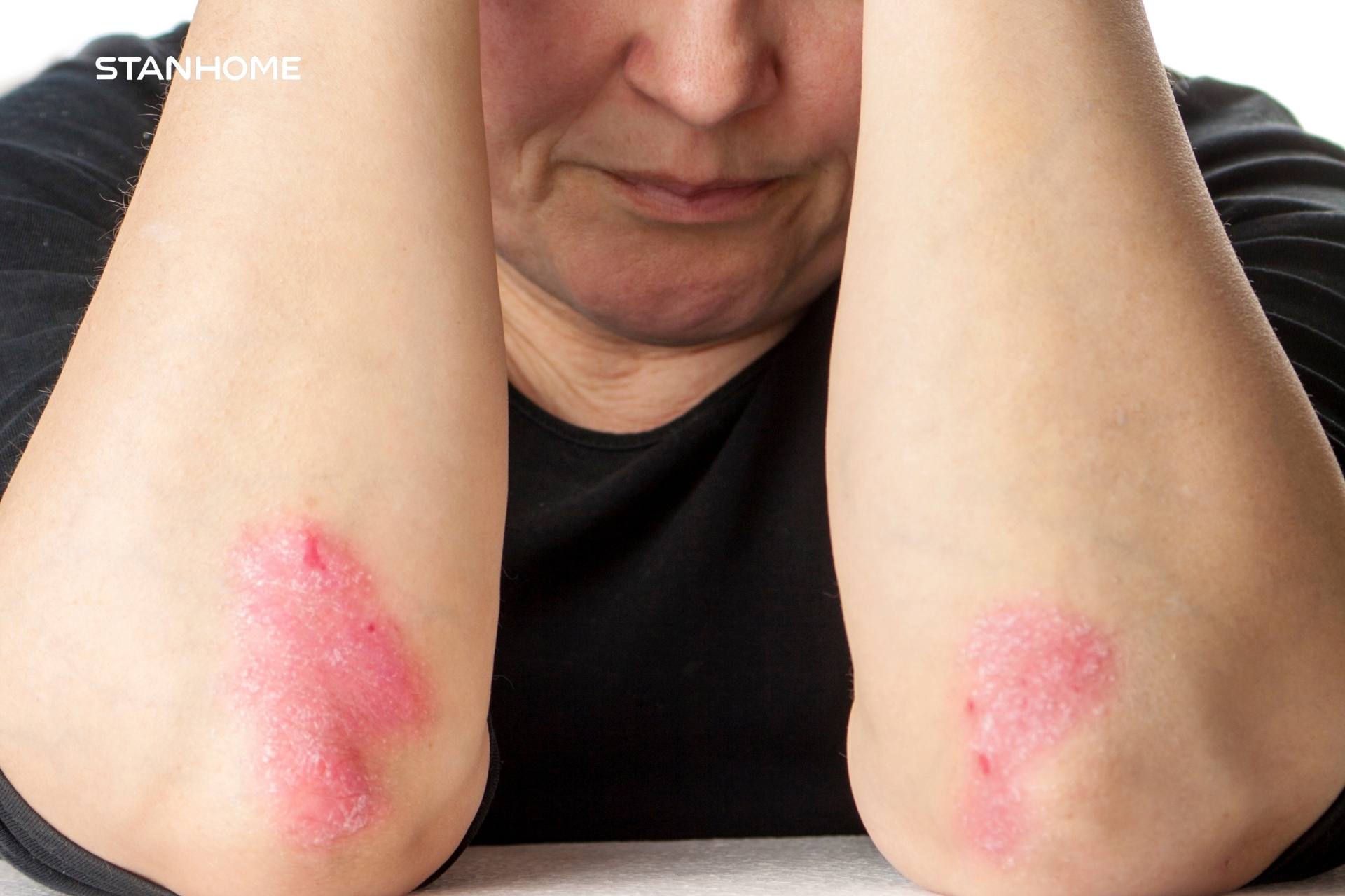 Các yếu tố gây khởi phát và làm bệnh tái phát bệnh vảy nến