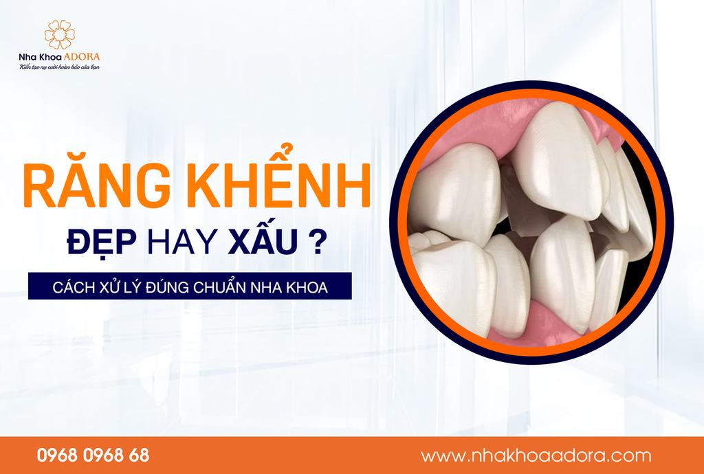 Răng Khểnh Đẹp Hay Xấu? Cách Xử Lý Đúng Chuẩn Nha Khoa