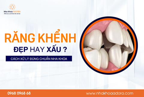 Răng Khểnh Đẹp Hay Xấu? Cách Xử Lý Đúng Chuẩn Nha Khoa