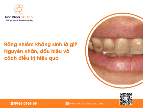 Răng nhiễm kháng sinh là gì? Nguyên nhân, dấu hiệu và cách điều trị hiệu quả