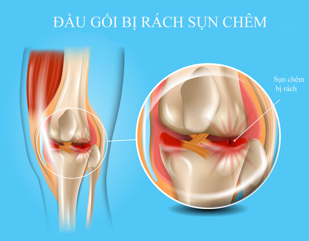 Đầu gối bị rách rụn chêm
