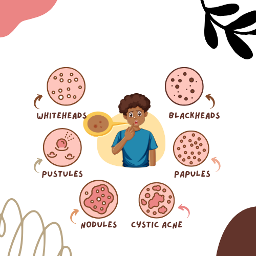 Tác Nhân Gây Mụn và Cách Phòng Ngừa