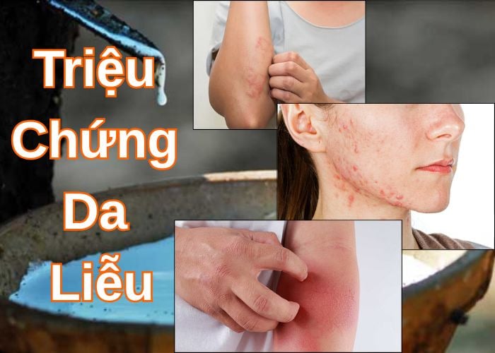 Triệu chứng phổ biến khi dị ứng latex