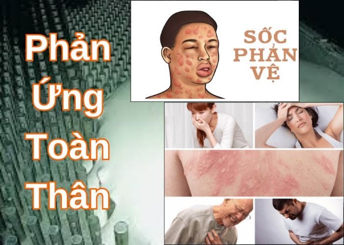 Triệu chứng nguy hiểm nhất - Sốc phản vệ