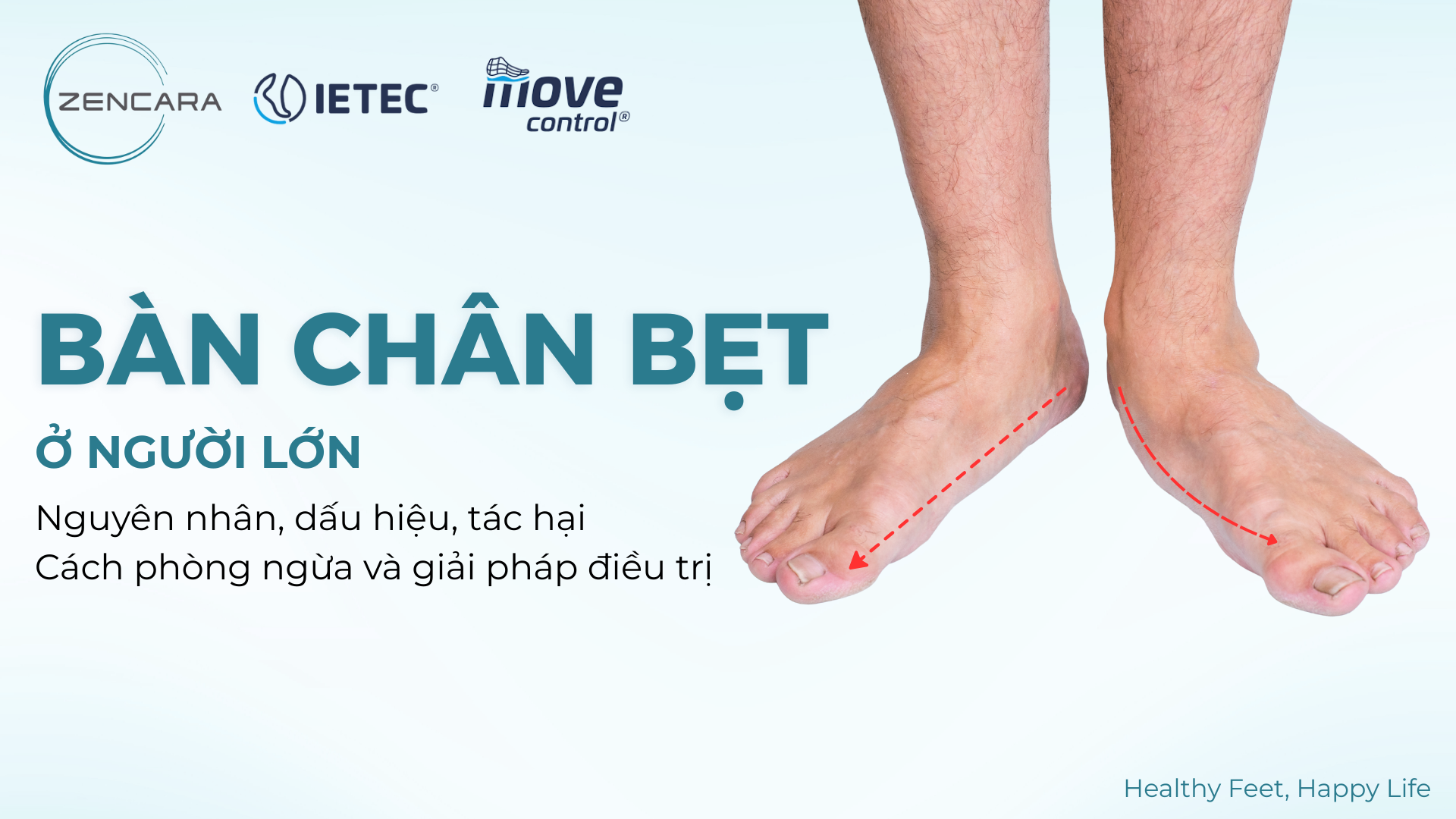 Hội chứng bàn chân bẹt ở người lớn: Nguyên nhân, triệu chứng và cách điều trị hiệu quả