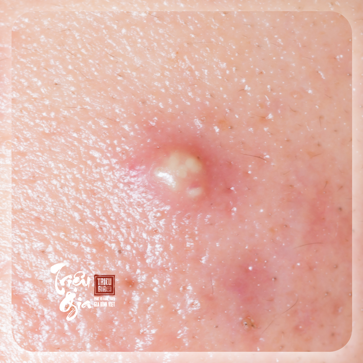 Cách trị mụn nhọt an toàn tại nhà mà ai cũng cần biết