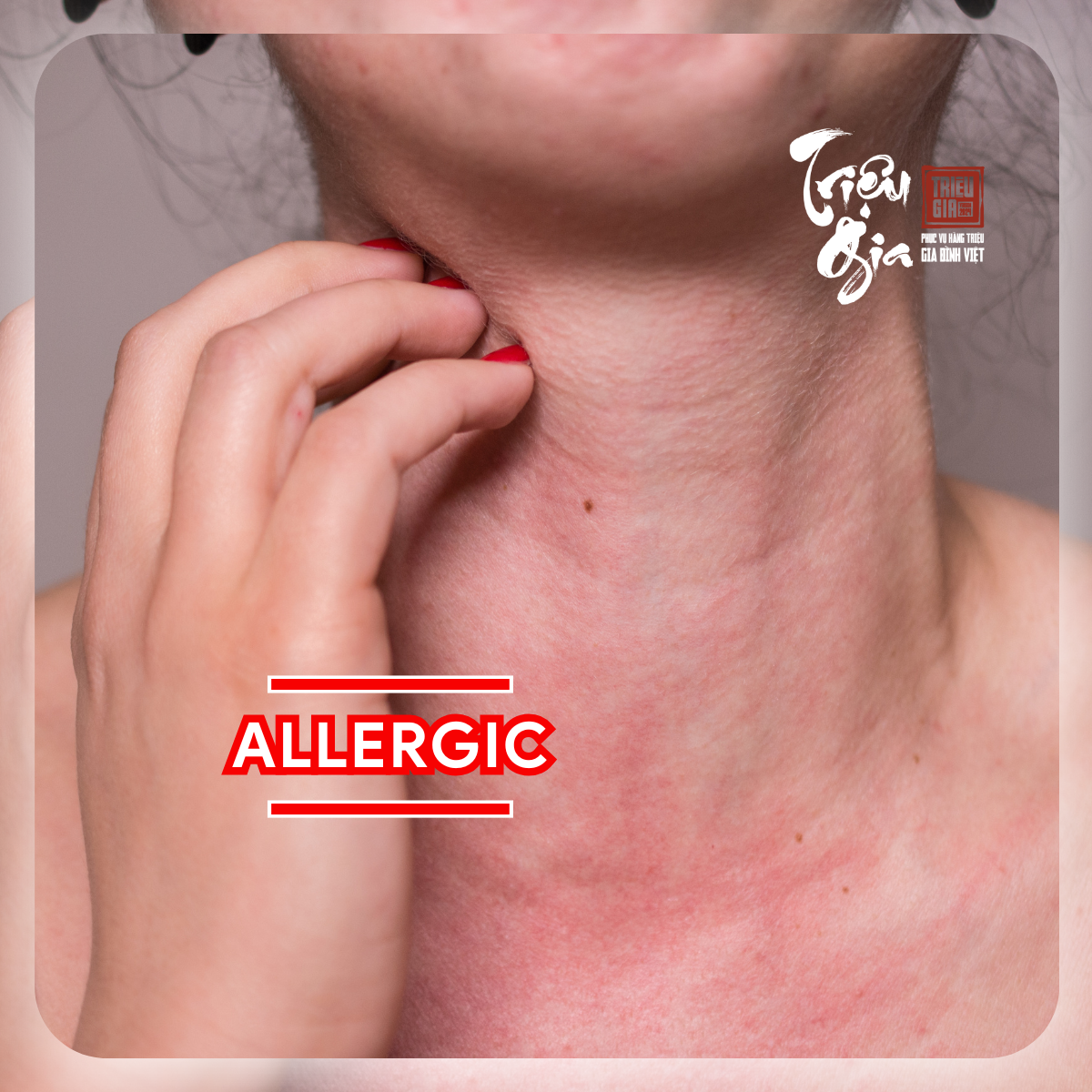 Dị ứng mỹ phẩm: Làm thế nào để cải thiện?