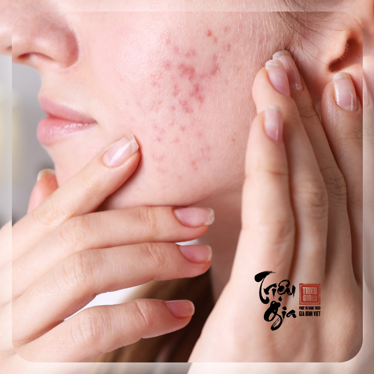 Nguyên nhân và cách trị mụn ẩn an toàn cho từng loại da