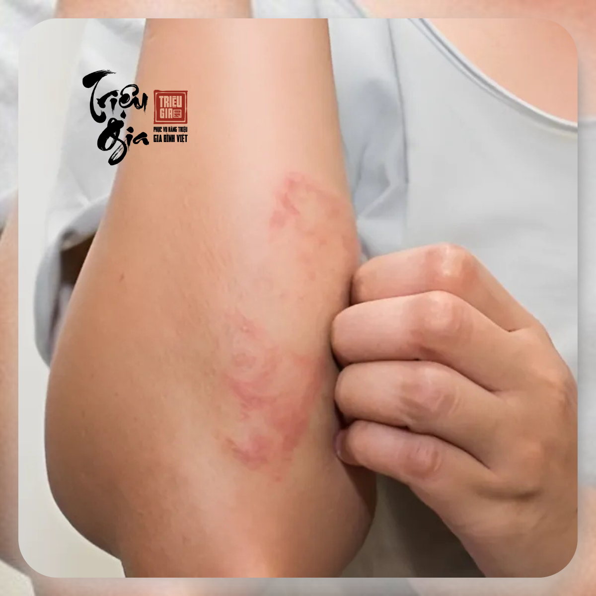 Viêm da dị ứng là gì? Dấu hiệu nhận biết và cách chữa trị