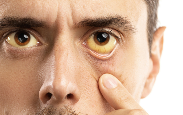 Vàng da, vàng mắt là những dấu hiệu dễ nhận biết khi nhiễm độc gan