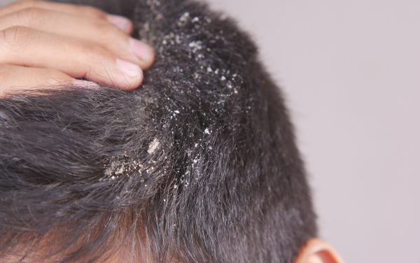Các bệnh lý về da đầu như gàu, nấm gây ngứa và rụng tóc