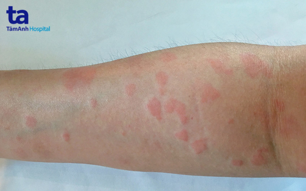 Dấu hiệu nhận biết lupus ban đỏ