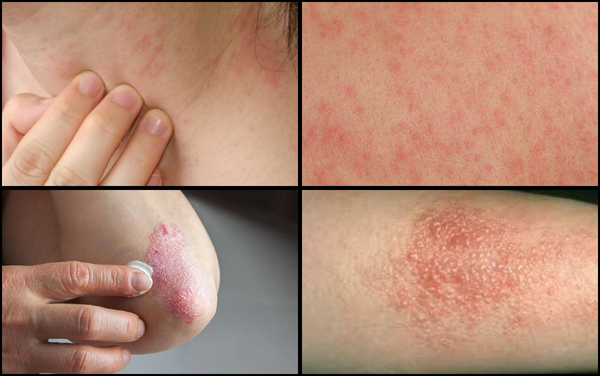 Da bị ngứa, đỏ, khô và thậm chí lên mụn nước là các dấu hiệu của bệnh dị ứng viêm