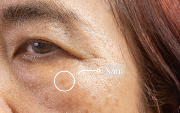 Vitamin E hỗ trợ giảm thâm nám, làm đều màu da