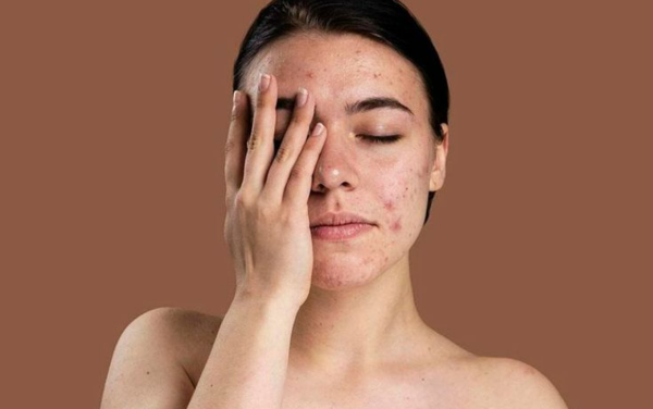 Khi da đạng bị mụn viêm hoặc có vết thương hở thì không nên xông mặt