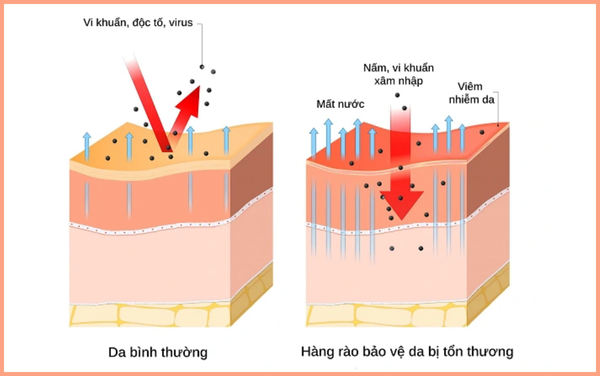 Hàng rào bảo vệ da suy yếu là nguyên nhân dẫn đến hầu hết vấn đề da, trong đó có viêm da dị ứng