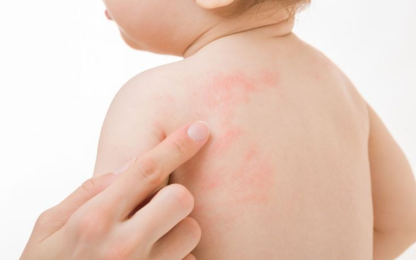 Trẻ bị dị ứng đạm sữa bò thường nổi mẩn đỏ sau khi uống sữa
