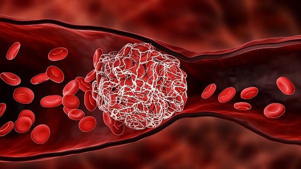 Lưu lượng máu lên não giảm gây ra tình trạng thiểu năng tuần hoàn
