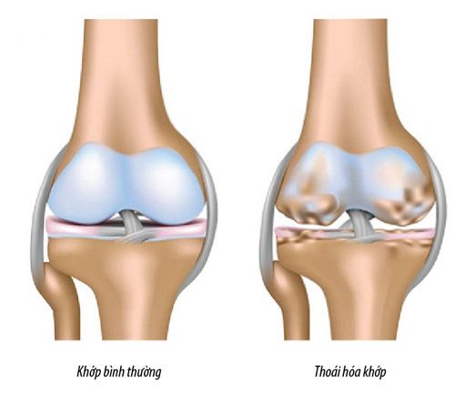 Hình minh họa cấu trúc xương khớp bị thoái hóa theo thời gian