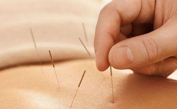 Châm và cứu là là hai bộ phận của phương pháp chữa bệnh