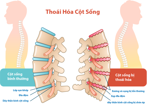 Chăm sóc cột sống bằng liệu pháp y học cổ truyền tại Hương Sen
