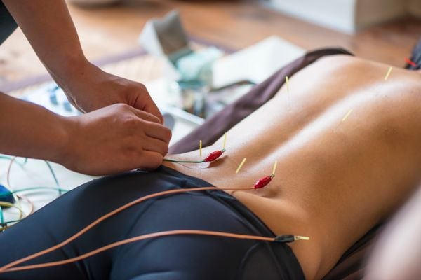 Kỹ thuật viên Hương Sen thực hiện châm cứu trị liệu cổ vai gáy