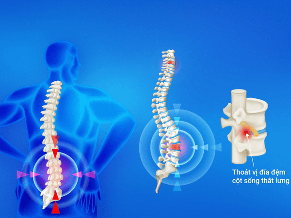 Thoát vị đĩa đệm gây ra đau lưng bên trái phía trên