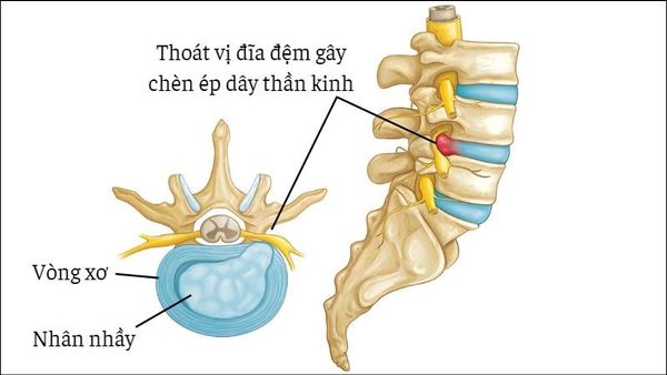 Xoa bóp bấm huyệt hỗ trợ điều trị thoát vị đĩa đệm an toàn