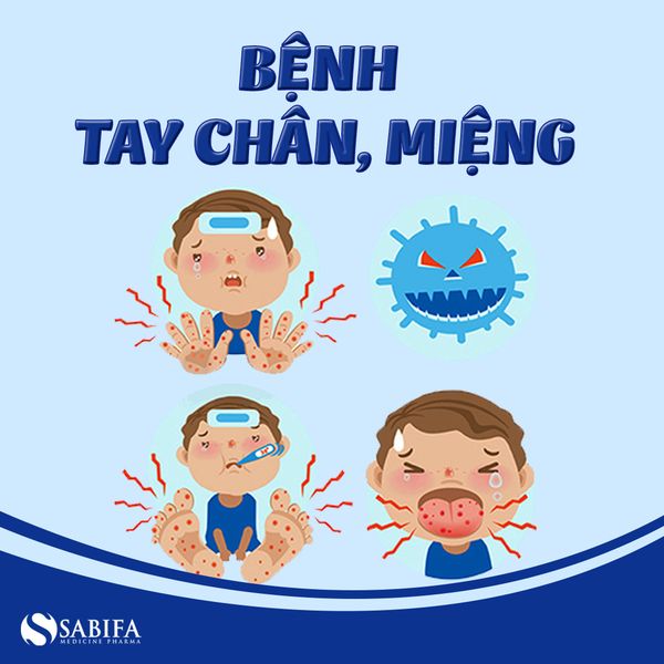 Tay chân miệng là bệnh thường gặp ở trẻ nhỏ khi giao mùa xuân - hè