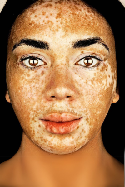 Sạm nám da: Nguyên nhân, triệu chứng và cách điều trị hiệu quả