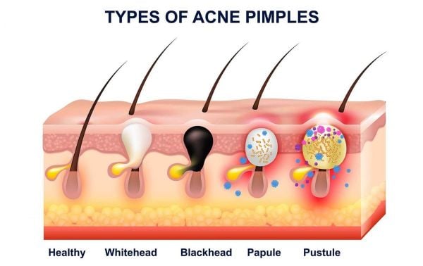 Cơ chế gây mụn: Vì sao skincare đúng vẫn bị mụn?