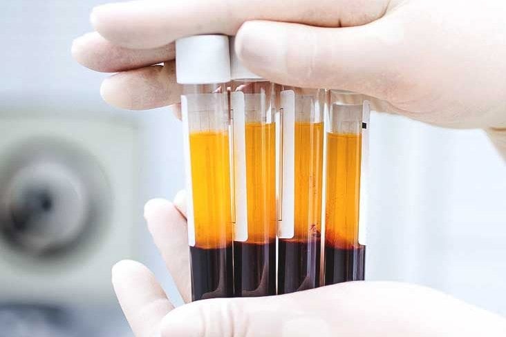 Liệu pháp PRP là gì? Hiệu quả, an toàn và lưu ý cần biết