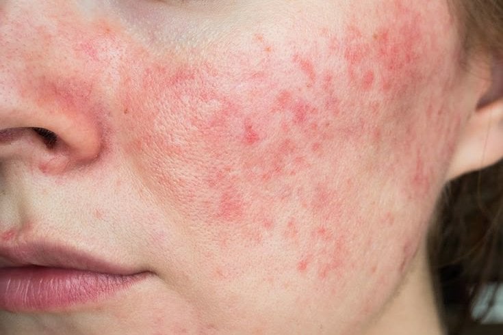 Rosacea là gì? Cơ chế, Giải pháp chuyên sâu & Cách chăm sóc
