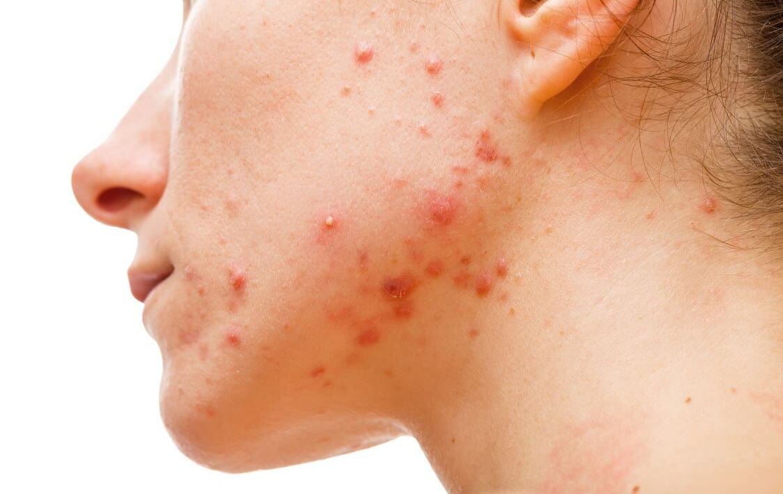 Mụn trứng cá ở người trưởng thành: Hiểu đúng để kiểm soát