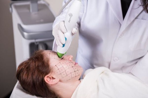 Thermage FLX là gì? Bí quyết nâng cơ da không cần dao kéo