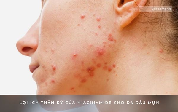Lợi Ích “Thần Kỳ” Của Niacinamide Với Da Dầu Mụn