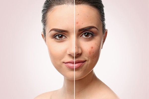 8 sai lầm phổ biến khi chăm sóc da dầu - khiến da bạn ngày càng tệ