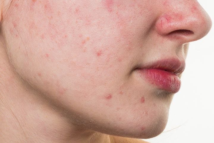 Da nhạy cảm là gì? Hiểu đúng để chăm sóc hiệu quả