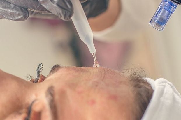 Tranexamic Acid: Giải pháp trị nám thay thế Hydroquinone?