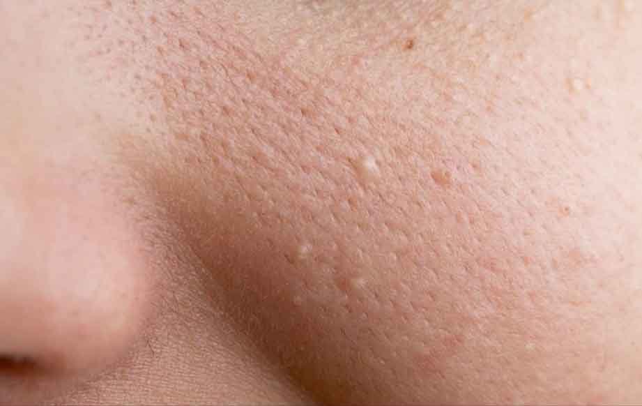 Mụn ẩn không viêm: Hiểu đúng để xử lý hiệu quả