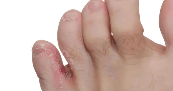 Tất xỏ ngón hỗ trợ chữa trị các bệnh có liên quan tới bàn chân