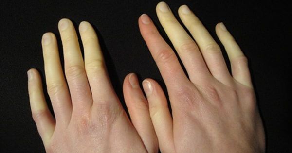 hoi chung raynaud