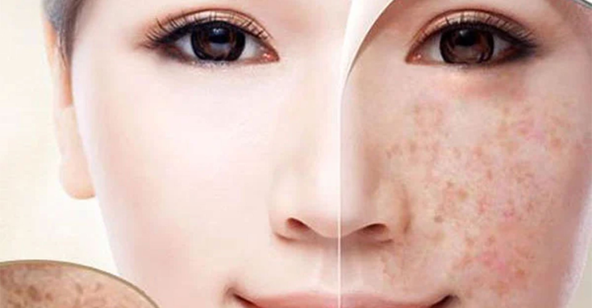 Nám da - hiểu đúng, điều trị đúng