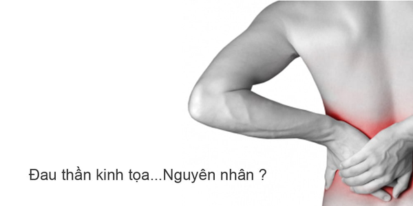 Đau thần kinh tọa do cấn... ví tiền
