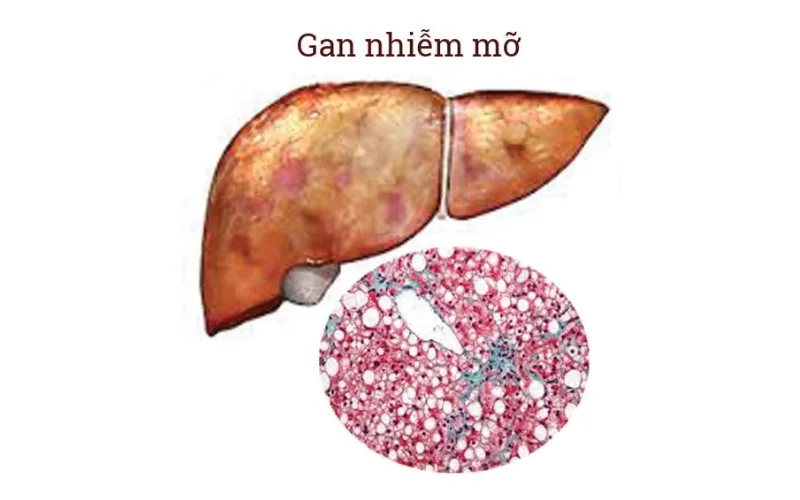Gan nhiễm mỡ có nguy hiểm không? Xáo tam phân hỗ trợ điều trị như thế nào?
